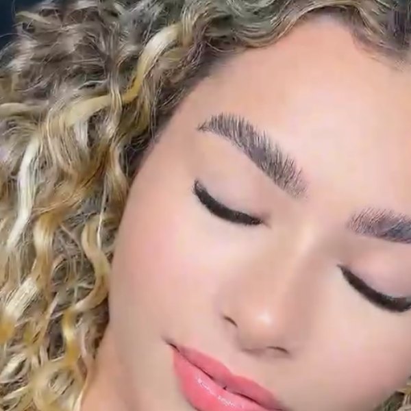 Botox no terço superior e preenchimento labial